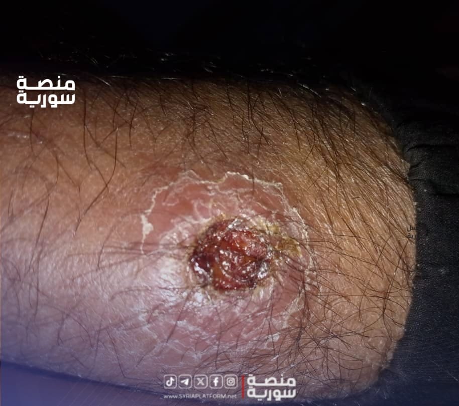 اللشمانيا في الرقة.. أزمة صحية تتشابك مع الفوضى البيئية والإدارية